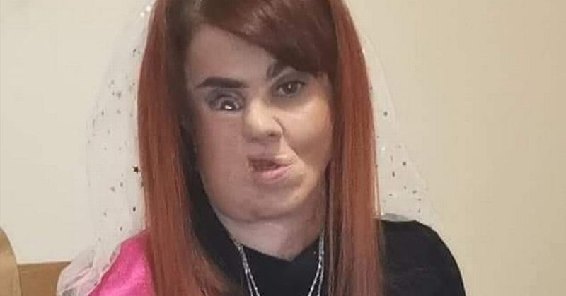 Woman who lost parts of face to flesh-eating bug left feeling like ‘freak show’