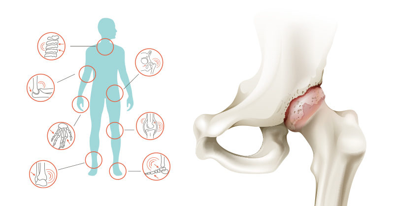 10 Home Remedies for Joint Pain and Arthritis