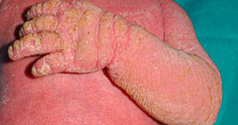 Baby Suffering From Incurable Rare Skin Disorder Receives Life Changing Treatment