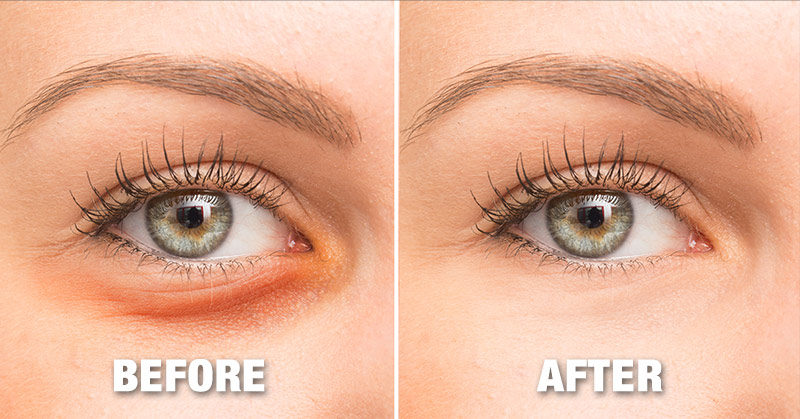 Why we get dark circles and how to get rid of them