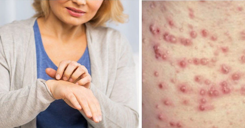 Eruptive Xanthomatosis Is A Skin Condition No One Should Ignore