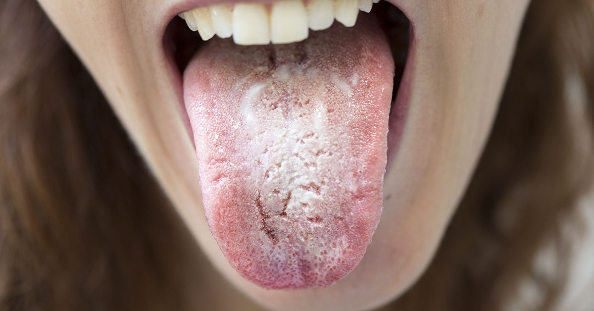 What is Candida Overgrowth, and Do You Have It?