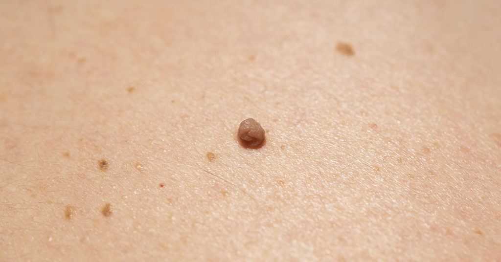 Natural Skin Care: What Can You Try To Remove Age Spots, Moles, Skin Tags, Warts, And Blackheads? - Featured image