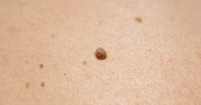 Natural Skin Care: What Can You Try To Remove Age Spots, Moles, Skin Tags, Warts, And Blackheads? - Featured image