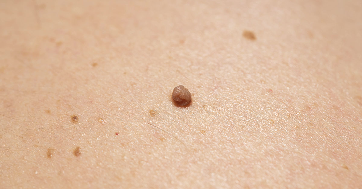 Natural Skin Care: What Can You Try To Remove Age Spots, Moles, Skin Tags, Warts, And Blackheads?