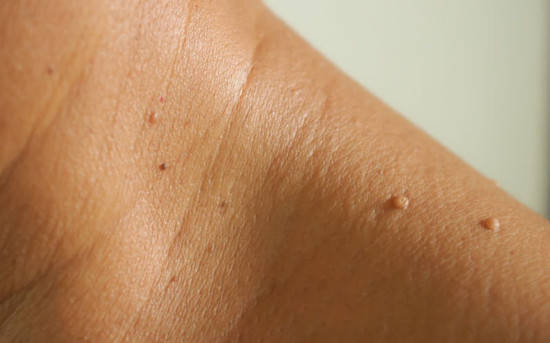 close up skin tags on neck shoulder area