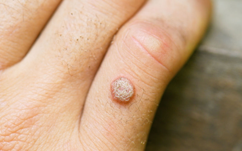 close of of hand with wart on pinky finger