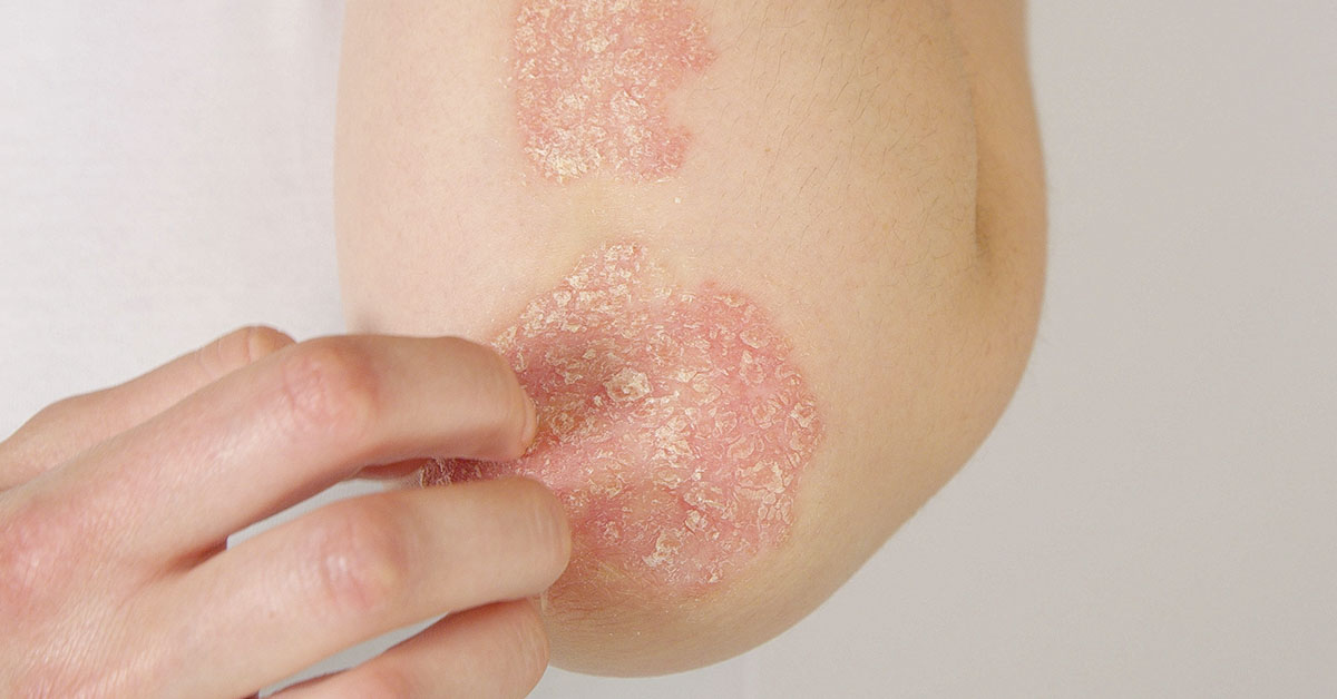 Woman Clears Psoriasis Covering 90% Of Body After Claiming She “Discovered Root Cause”