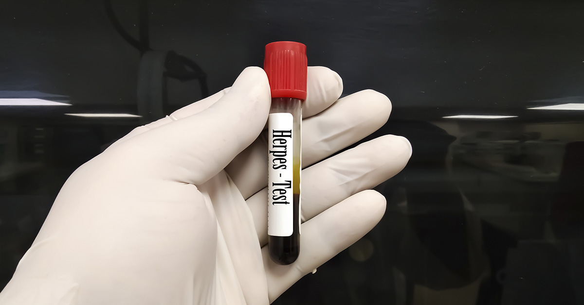 ‘I Thought I Had A Headache. It Turned Out To Be Herpes (HSV-1) — In My Brain.’