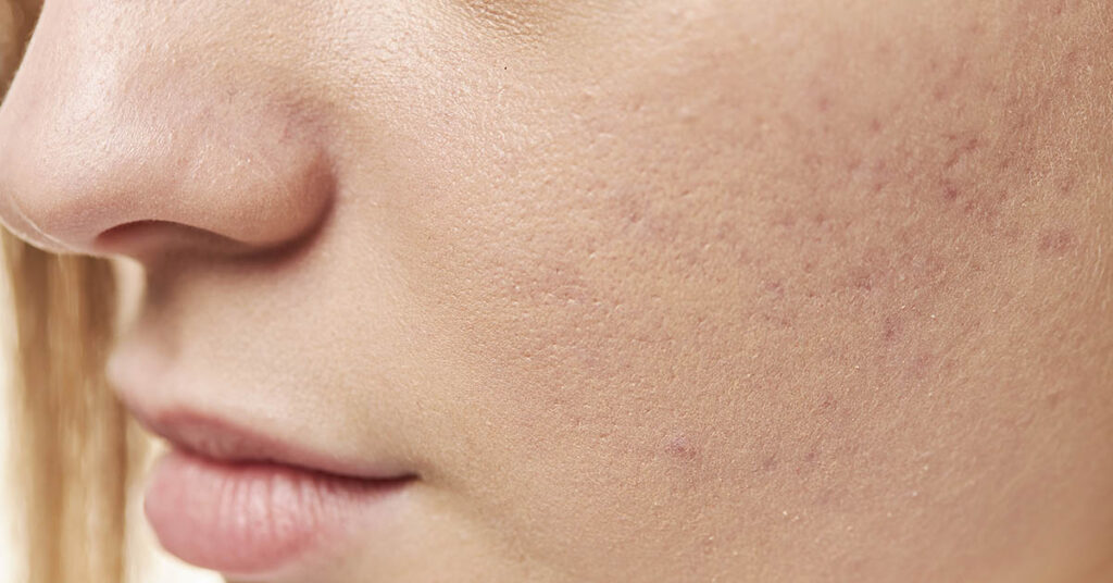 8 Vitamin Deficiencies That Show Up On Your Skin - Featured image