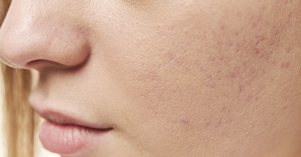 8 Vitamin Deficiencies That Show Up On Your Skin