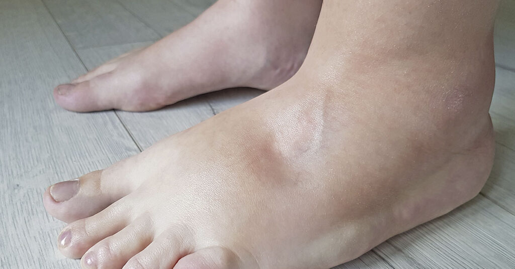 Woman’s foot was swollen for years, then she finally pays the doctor a visit to learn why - Featured image