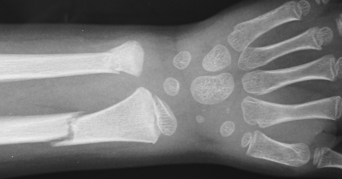 The Weird and Concerning Reason Human Bones Are Getting More Brittle