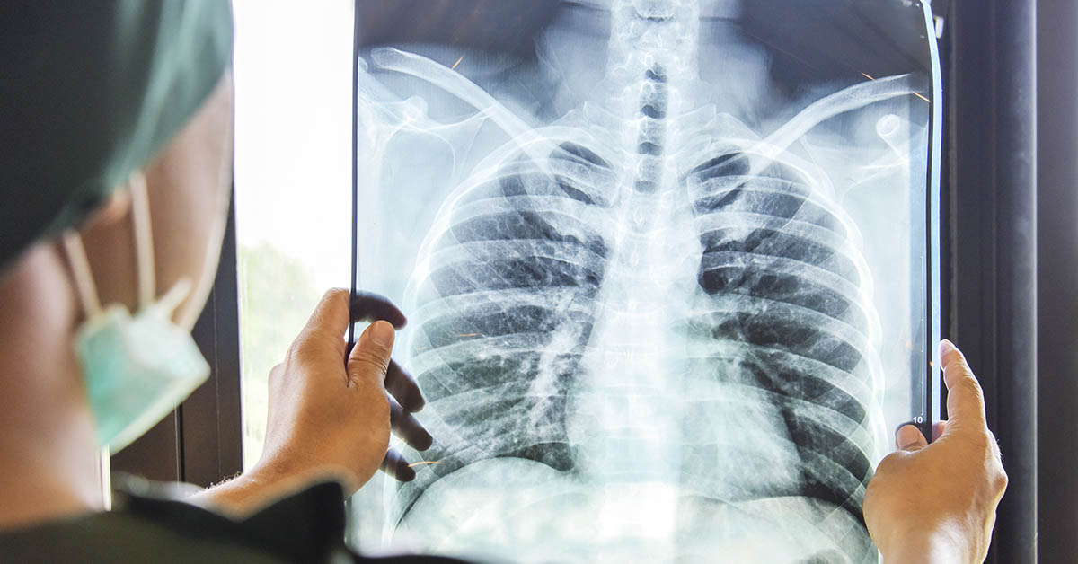 10 Warning Signs of Lung Cancer