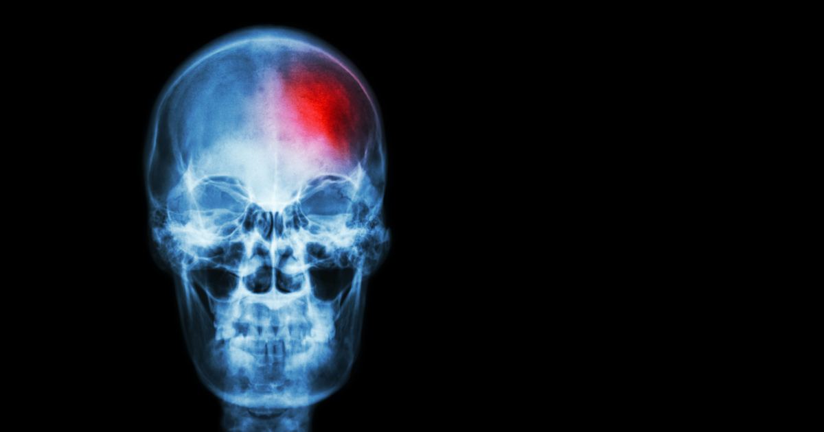 Half of Stroke Patients Notice These Warning Signs a Week Before—Are You at Risk?