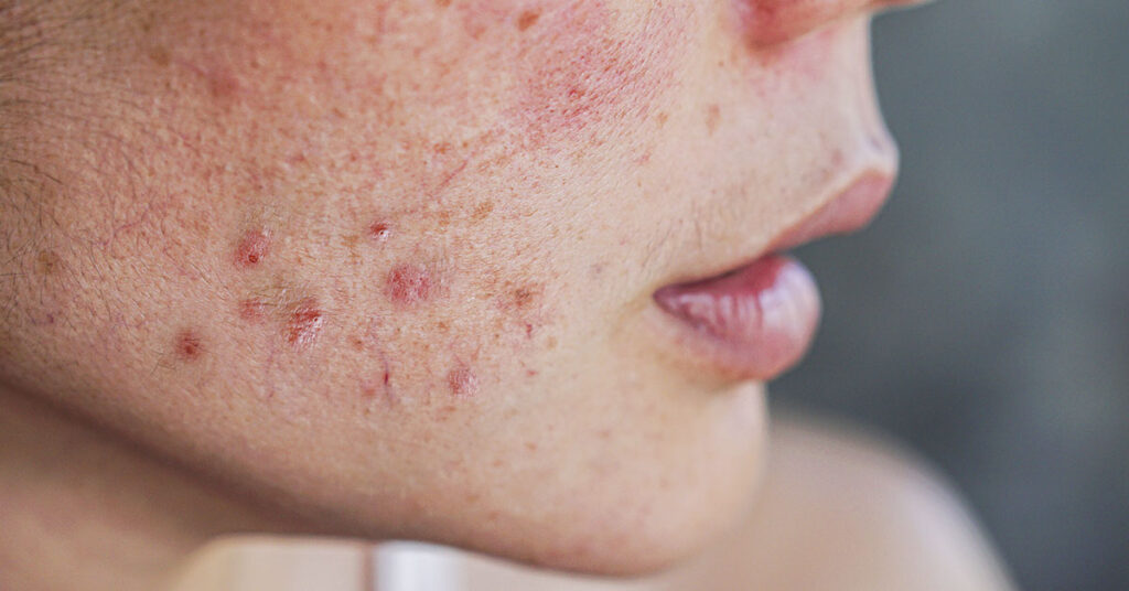 Do Vitamin B12 Supplements Cause Acne, Bone Fractures, and Lung Cancer? - Featured image
