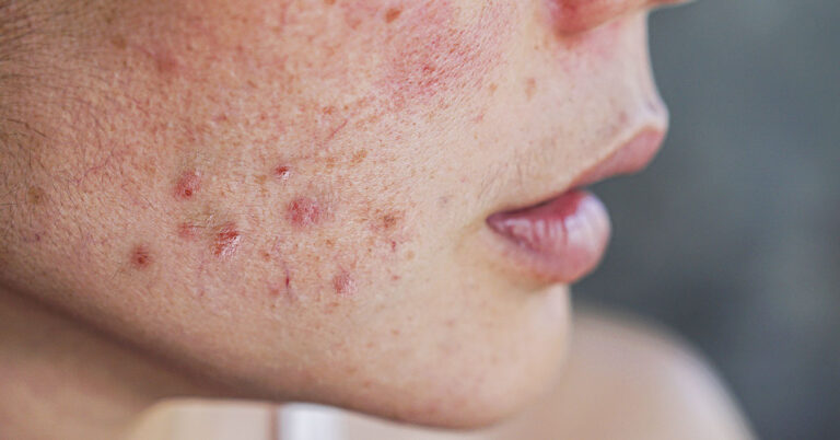 Do Vitamin B12 Supplements Cause Acne, Bone Fractures, and Lung Cancer? - Featured image