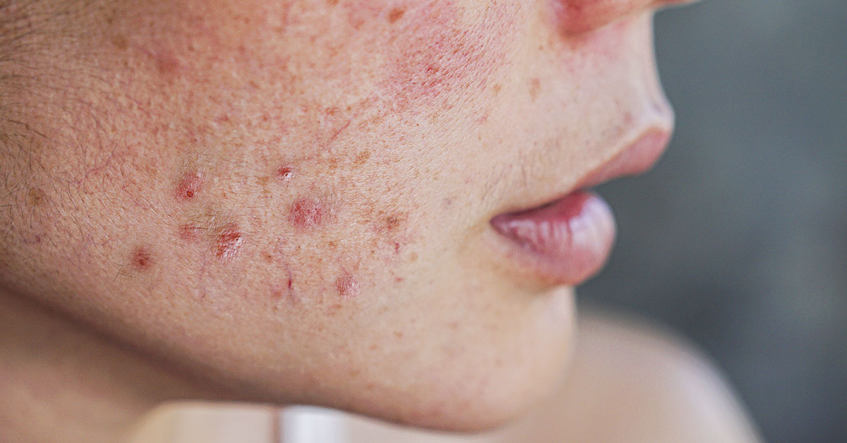 Do Vitamin B12 Supplements Cause Acne, Bone Fractures, and Lung Cancer?