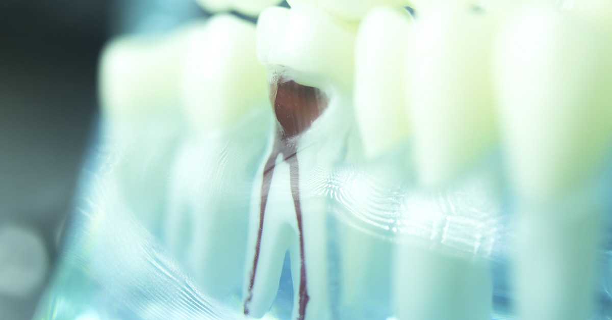 Fact Check: Are root canals dangerous, and do they increase your risk of chronic disease?