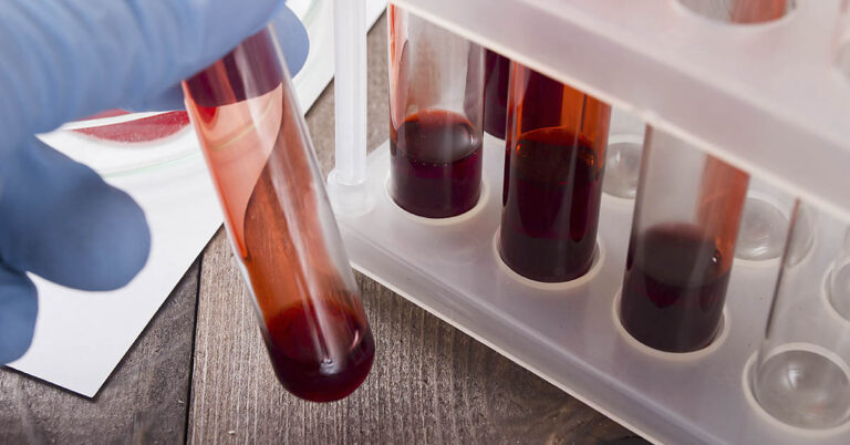 Could Stem Cells from Menstrual Blood Help Treat Diseases Like Alzheimer’s? - Featured image