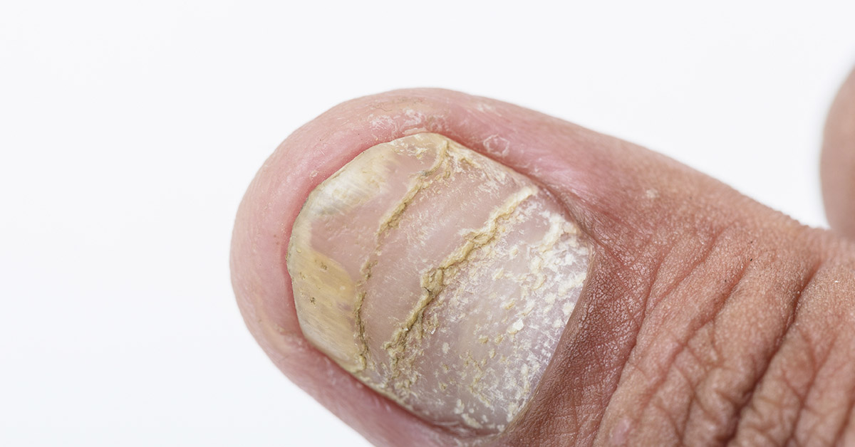 Why Your Nails Keep Peeling and Flaking—and What to Do About It