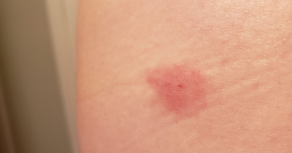 Insect bite on light colored skin pink irregular rash