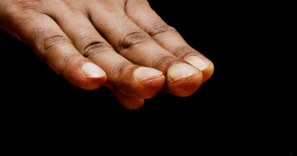 Clubbed Fingernails
