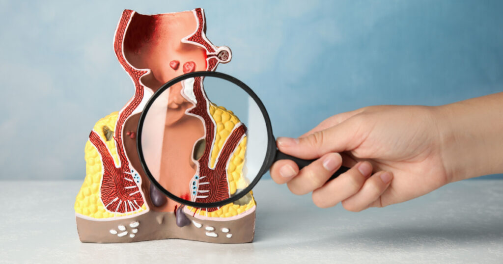 Doctor with magnifying glass showing model of unhealthy lower rectum on light blue background, closeup. Hemorrhoid problem
