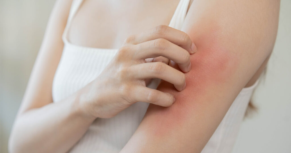 Dermatology, asian young woman, girl allergy, allergic reaction from atopic, insect bites on her arm, hand in scratching itchy, itch red spot or rash of skin. Healthcare, treatment of beauty.