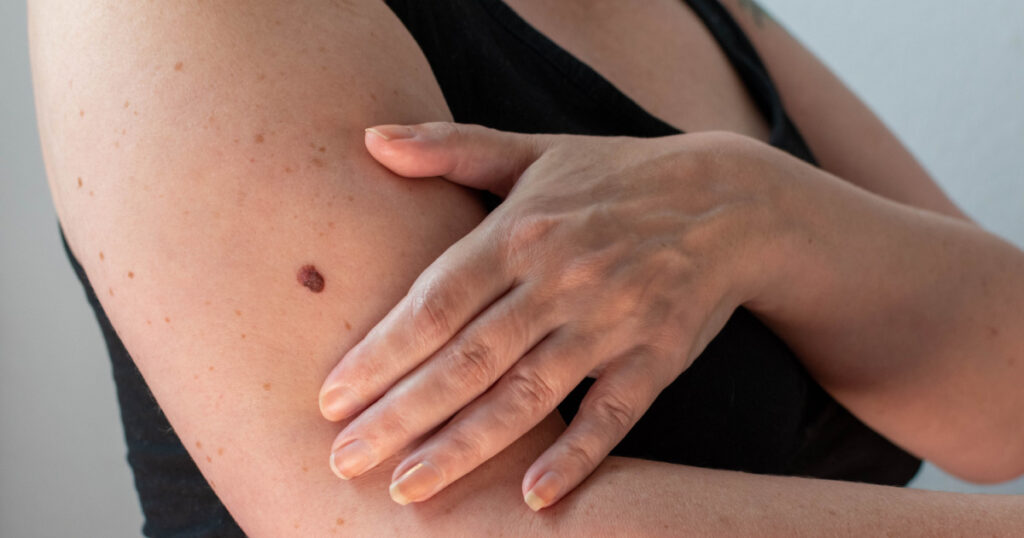 a large and unusual mole or freckle on a woman's arm was diagnosed as malignant melanoma skin cancer
