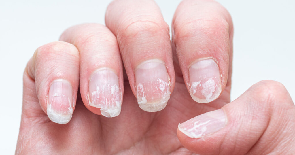broken peeling nails