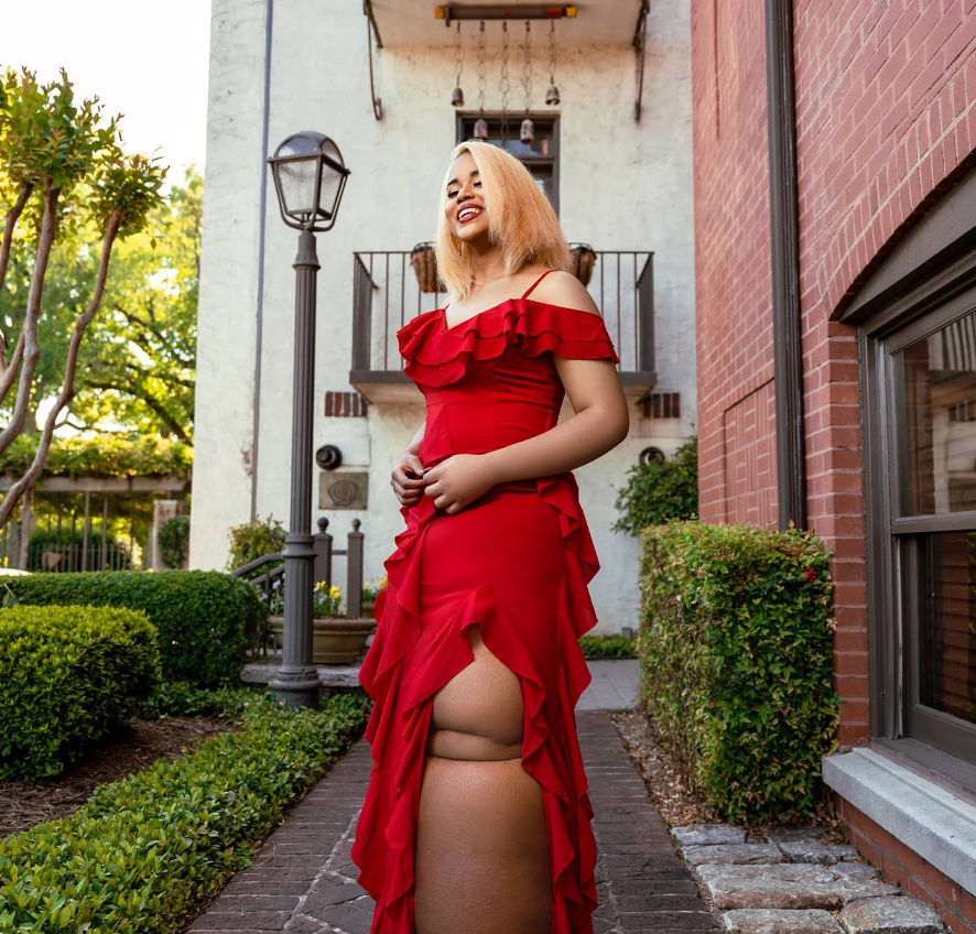 model with lymphedema