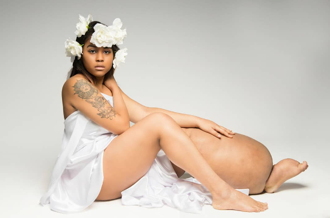 model with lymphedema