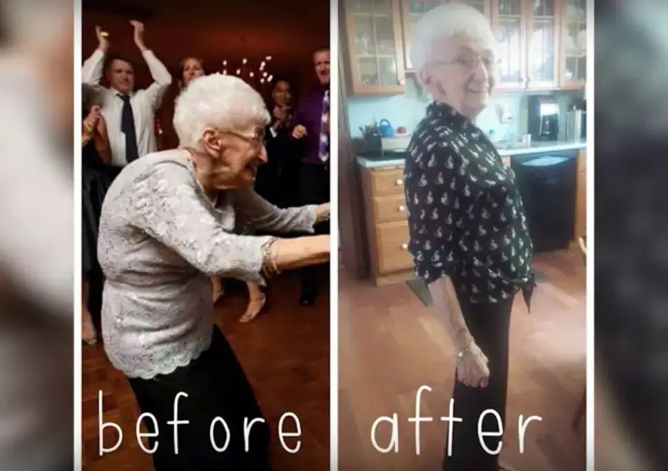 Anna Pesce before and after using yoga to help treat her scoliosis 