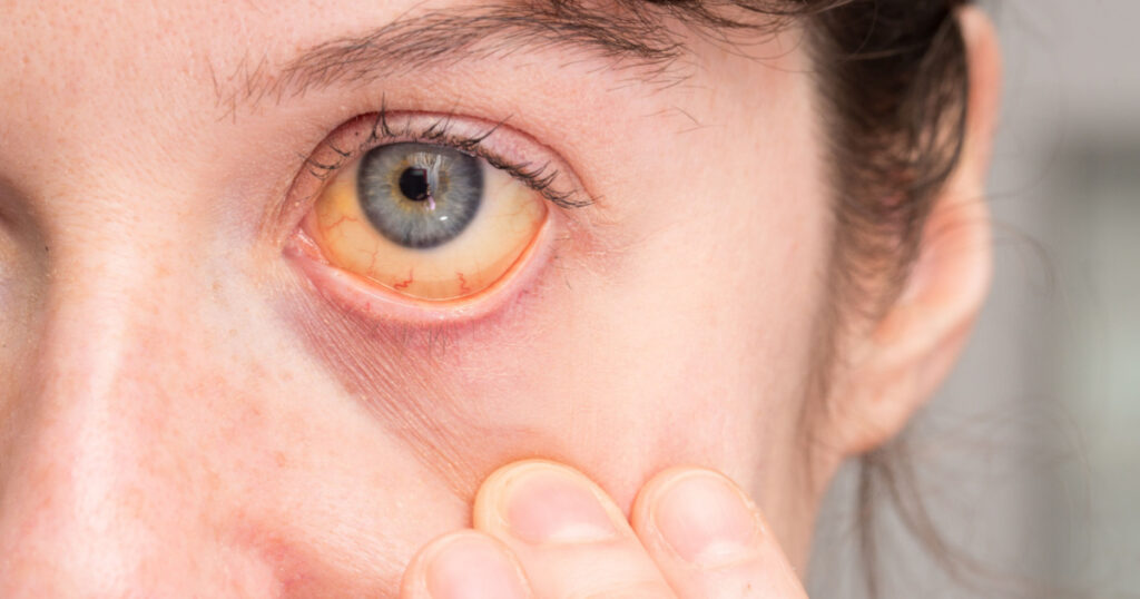 Close-up of girl's eye with yellow sclera caused by jaundice