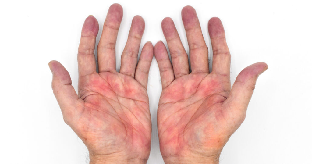 Palmar erythema often called liver palms in both hands of Southeast Asian, Myanmar man. Isolated on white background.
