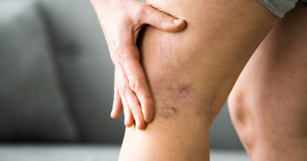 Before After Cellulite Inflammation Legs Treatment Closeup