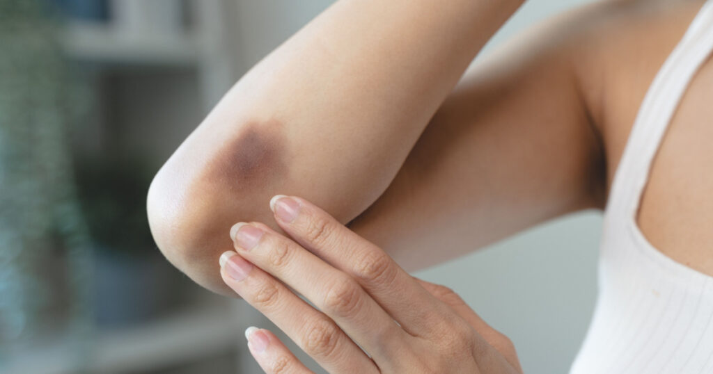 woman get injured and have bruised on her arm.