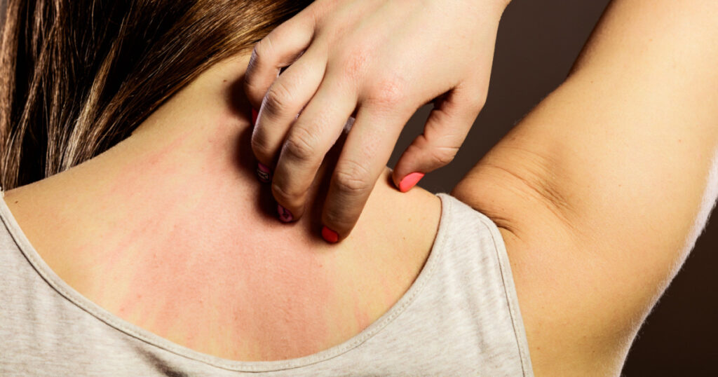 Health problem. Closeup young woman scratching her itchy back with allergy rash