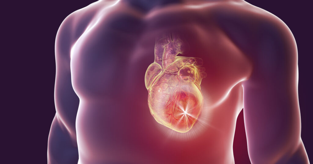 Heart attack, conceptual image for heart diseases. 3D illustration
