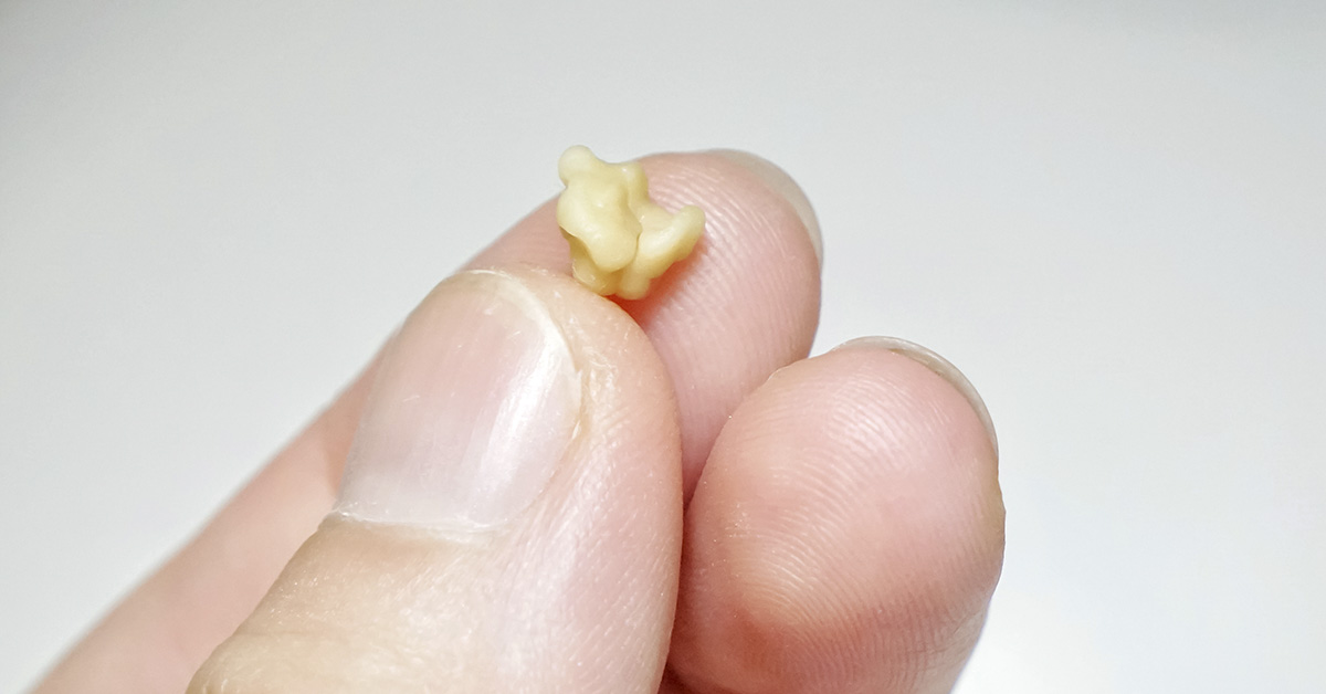 Here’s What You Need to Know About Tonsil Stones
