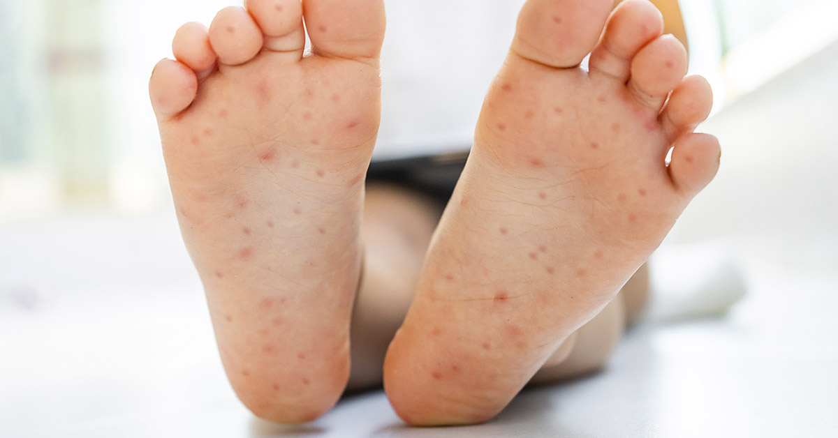 7 Warning Signs of Hand-Foot-and-Mouth Disease Parents Need to Look Out For 