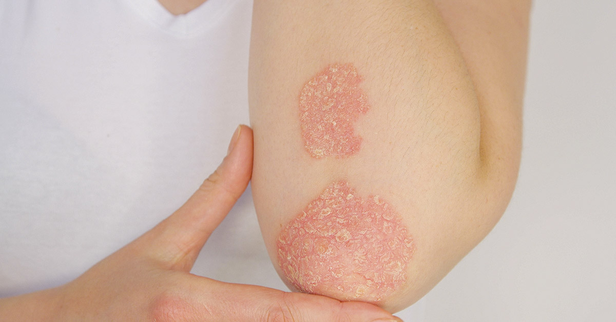 10 Ways to Help Beat Psoriasis Naturally