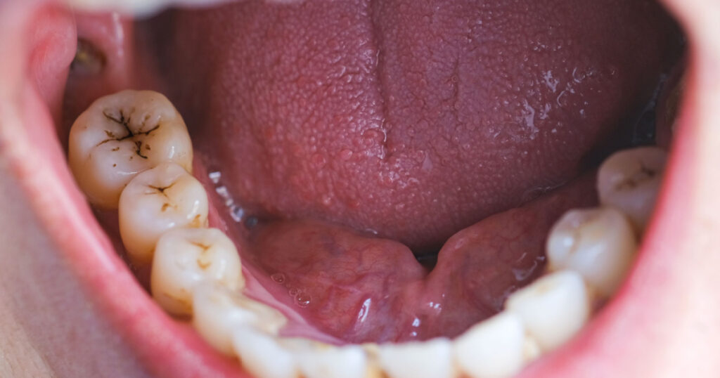 Tooth's a man smoking bad. woman smokes a cigarettes have tooth decay and calculus on teeth, So we should be care dental with the hygiene.
