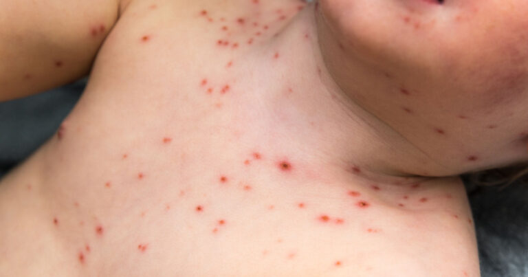 Mom’s Facebook Post Serves as a Reminder Why  You Shouldn’t Treat Chickenpox with Ibuprofen - Featured image