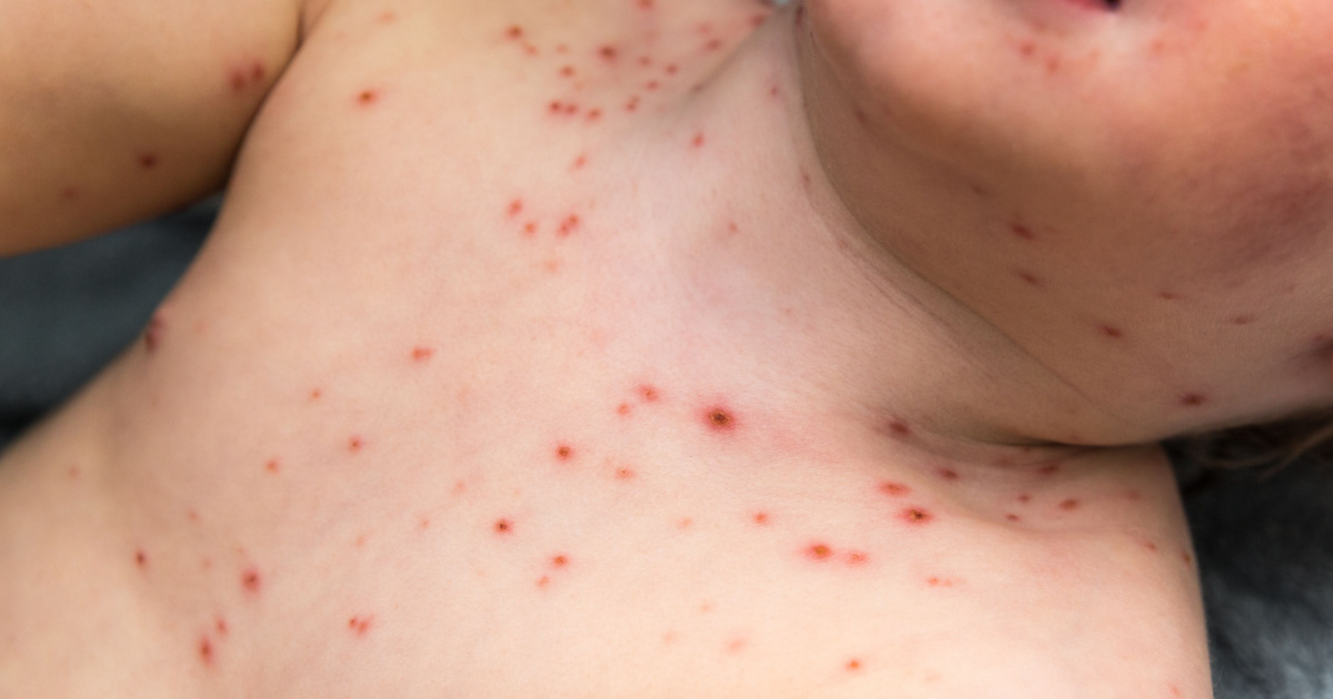 Mom’s Facebook Post Serves as a Reminder Why  You Shouldn’t Treat Chickenpox with Ibuprofen