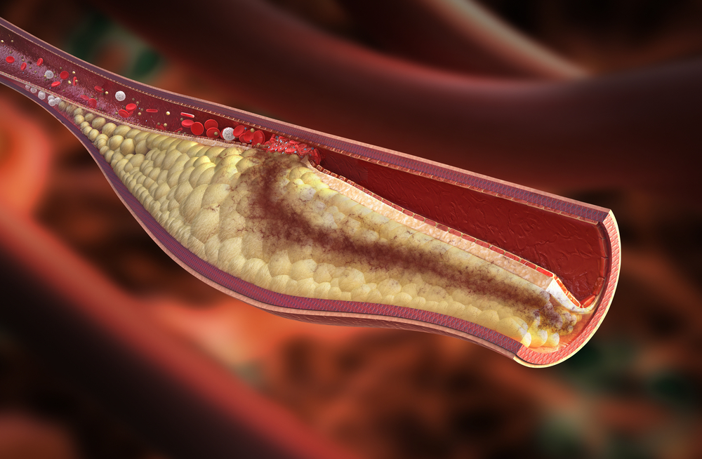 Atherosclerotic plaque development. High detail image of unstable atherosclerotic plaque condition. Path is included if you want to separate vein from the background.