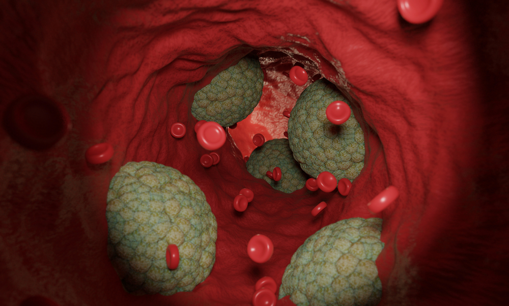 Cholesterol deposits in the artery, vein. Hypertension problem, heart attack. Improper care for human health.