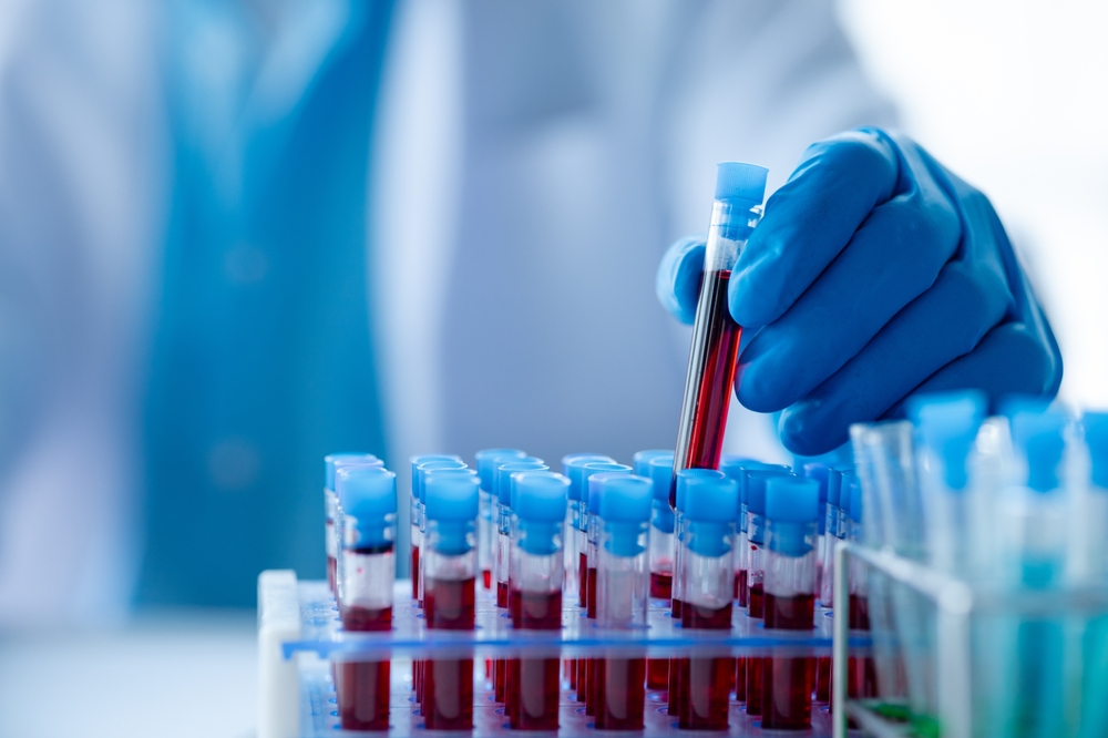 Lab assistant, a medical scientist, a chemistry researcher holds a glass tube through the blood sample, does a chemical experiment and examines a patient's blood sample. Medicine and research concept.