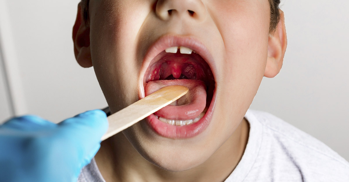 The Benefits and Risks of Removing Children’s Tonsils and Adenoids